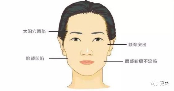 另外,颧骨突出跟太阳穴凹陷又属于不同的情况,有人只占了一个,有人