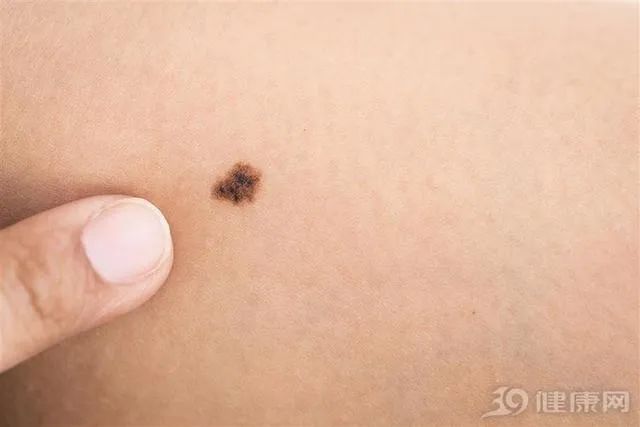 再次提醒:长在9个部位的痣,与癌症"密不可分",要及时处理