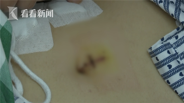 女子国外误吞牙签 强忍两个多月回国才取出