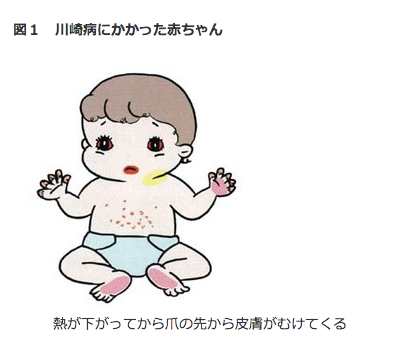 全球范围内报告更多儿童患罕见综合征。／《卫报》网页