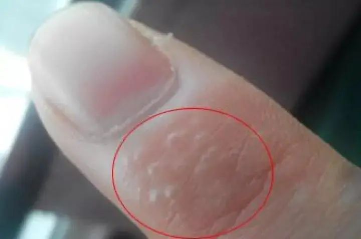 姑娘手指长满小水泡还脱皮,医生:这症状夏天高发