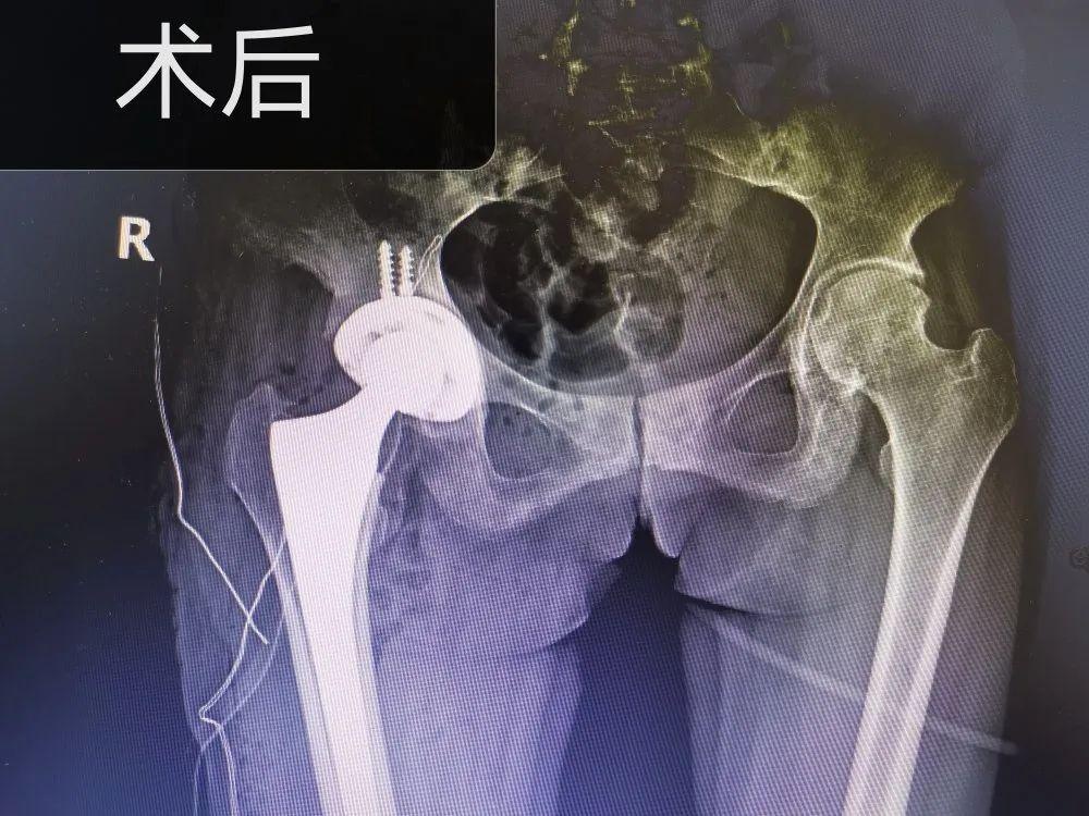发生了什么?让股骨头坏死患者丢掉拐杖