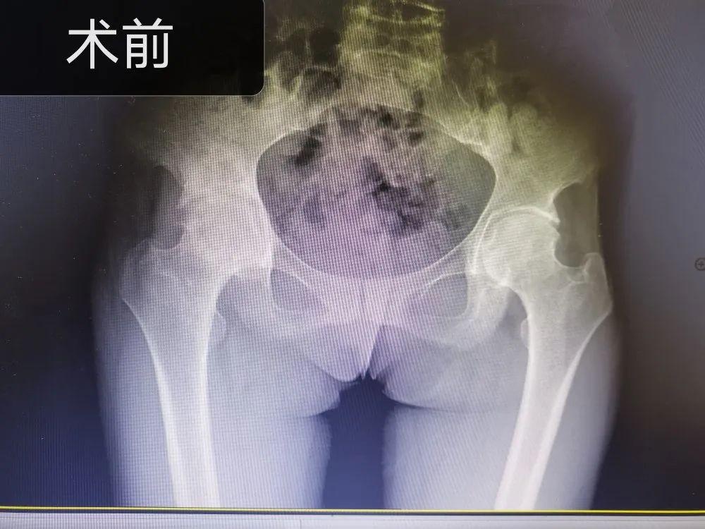 发生了什么?让股骨头坏死患者丢掉拐杖