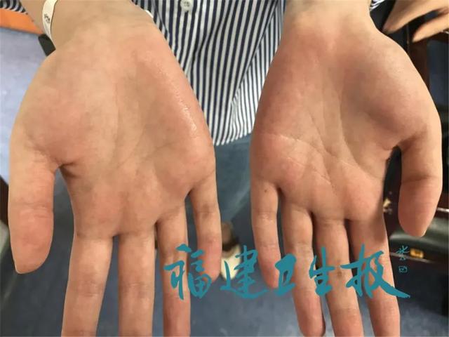 尴尬!福建女孩双手出汗近20年,连握手都害怕!这样根治,快转告身边的“水手”