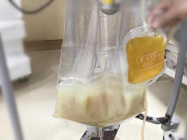 爱吃烧烤油炸食物,台州小伙患急性胰腺炎,差点把自己“消化”掉了