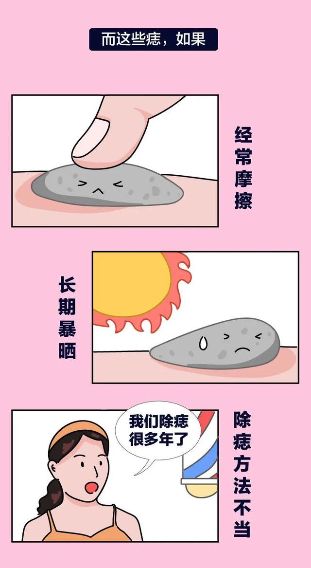 长这种痣可能会癌变,这5种痣不容忽视