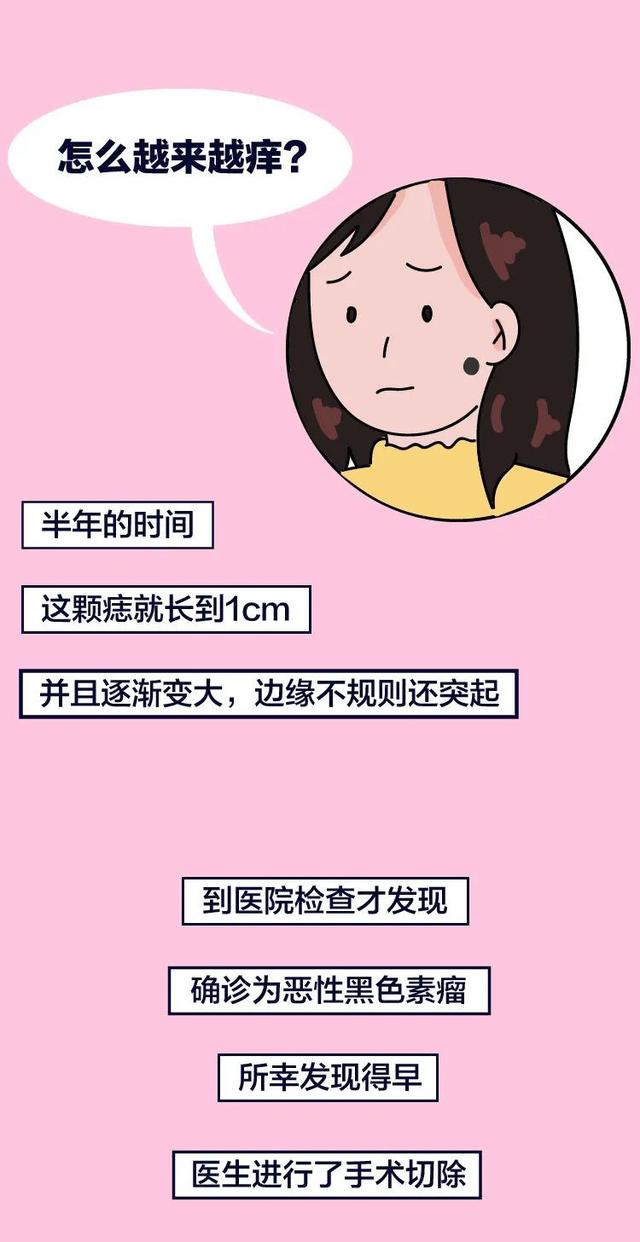 长这种痣可能会癌变,这5种痣不容忽视