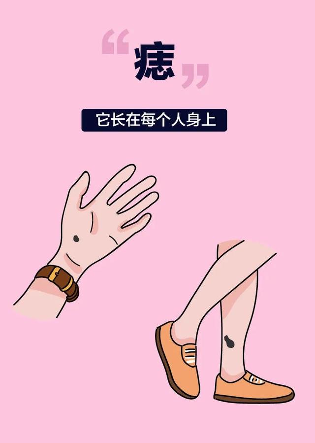 长这种痣可能会癌变,这5种痣不容忽视
