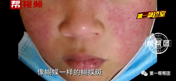 "红色的斑疹,像蝴蝶斑"女子身患尿毒症,竟与脸上红斑有关
