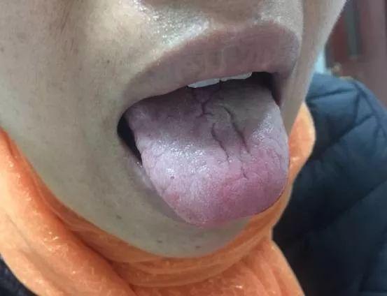 你舌头上有裂纹吗?注意了