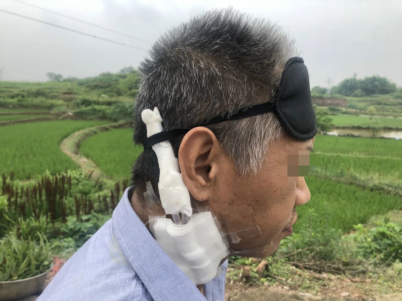 右颈部的留置导管,是身患尿毒症的廖银超血液透析的生命通路。新京报记者杜雯雯摄