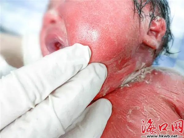 海口一女婴出生时满身"鱼鳞" 皮肤干枯如老人