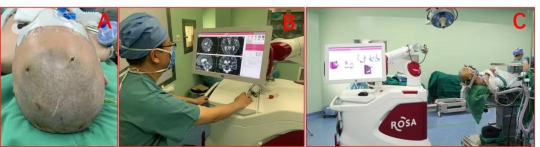 脑深部电刺激促醒长期意识障碍患者