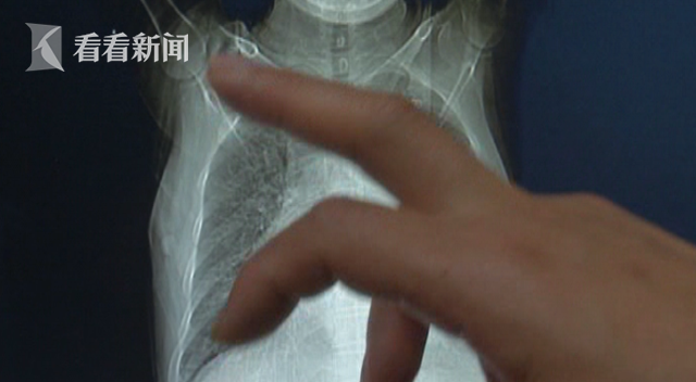 56岁女子肚大如怀胎九月孕妇 医生一查问题大了