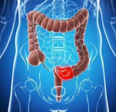 经常腹泻、腹胀、腹痛,还不知道原因?你可能患了一种肠胃病