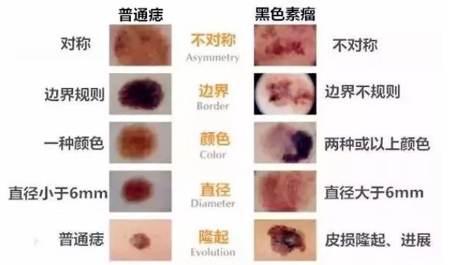 痣也可能癌变?赶紧看看,身上有这些痣要小心了!