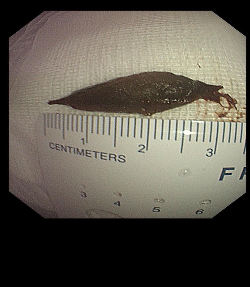 百岁老人吃粽子误吞枣核辗转多家医院,上海医生2分钟取出休闲区蓝鸢梦想 - Www.slyday.coM 百岁老人吃粽子误吞枣核辗转多家医院,上海医生2分钟取出休闲区蓝鸢梦想 - Www.slyday.coM