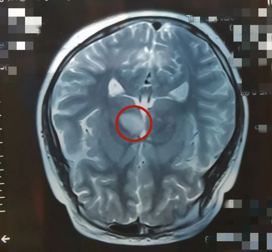田田的头颅MRI,红圈部位为脑梗塞