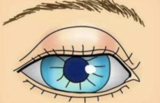 麦粒肿和霰粒肿有啥区别 看完这篇文章你就懂了