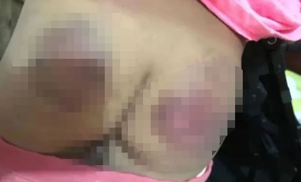 身上多处淤青!柳州融水10岁女生遭老师殴打?回应来了