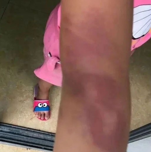 身上多处淤青!柳州融水10岁女生遭老师殴打?回应来了