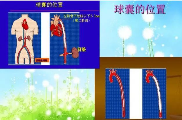 主动脉球囊反博术后护理