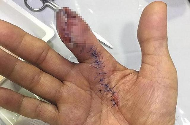 新加坡男子洗虾手指被刺破,竟只能断指保命,医生:晚一天切胳膊休闲区蓝鸢梦想 - Www.slyday.coM 新加坡男子洗虾手指被刺破,竟只能断指保命,医生:晚一天切胳膊休闲区蓝鸢梦想 - Www.slyday.coM