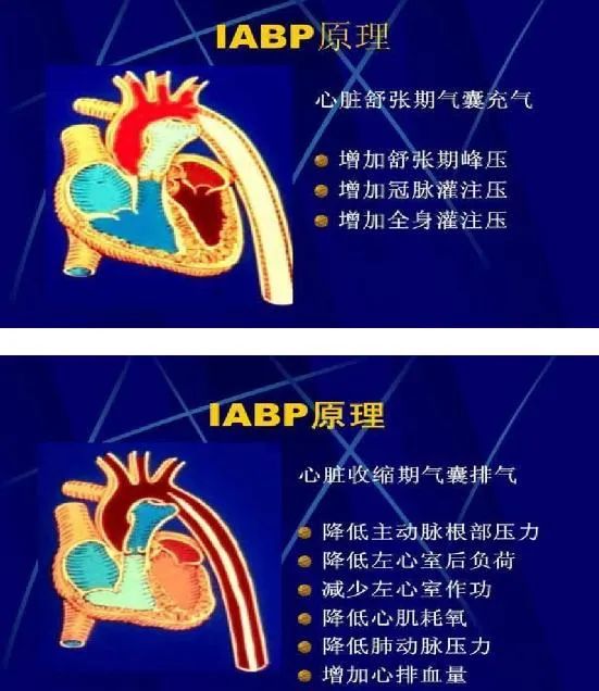主动脉球囊反博术后护理