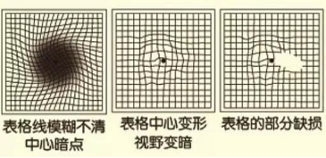 你知道吗?老年黄斑变性是主要致盲眼病之一