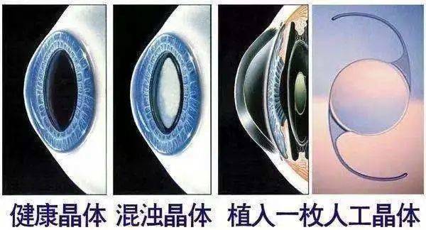 山东省知名眼科专家马先祯:白内障手术早已不是单纯的复明手术