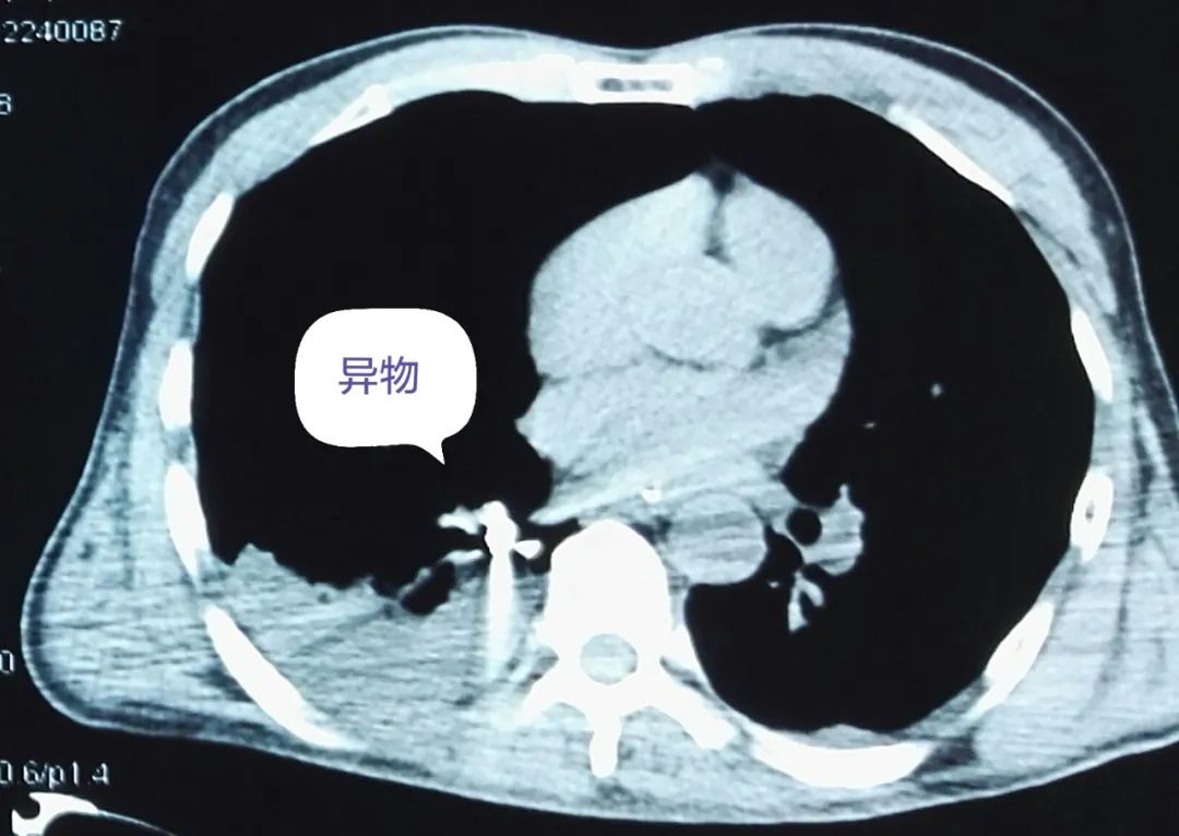 主任!患者把枪头吞下去了……