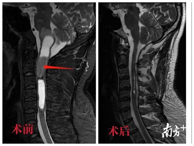 男子颈椎肩颈疼,竟是脖子里长了个鸡蛋大的肿瘤