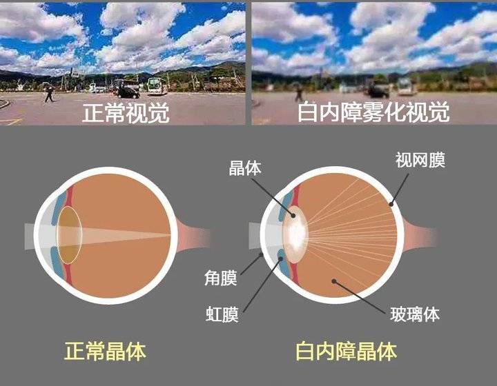山东省知名眼科专家马先祯:白内障手术早已不是单纯的复明手术