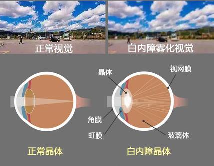 山东省知名眼科专家马先祯:白内障手术早已不是单纯的复明手术