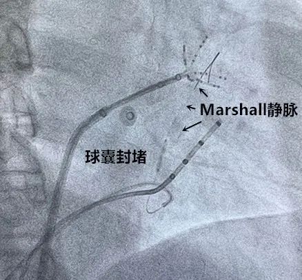 marshall静脉解剖,marshall韧带解剖 将纤细的导丝放进marshall静脉,用球囊堵住静脉入口,注射无水酒精