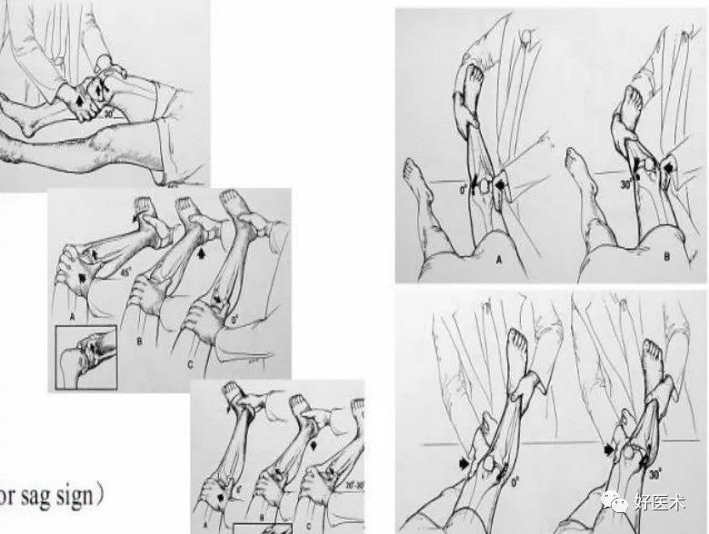 3)半月板 – 关节线压痛 – mcmurray test:弹响