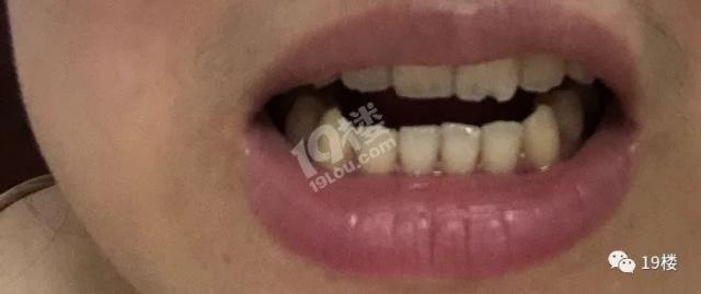 梦境解析,下门牙掉落与血痕——潜藏的内心不安与自我觉醒 梦境解析,下门牙掉落与血痕——潜藏的内心不安与自我觉醒