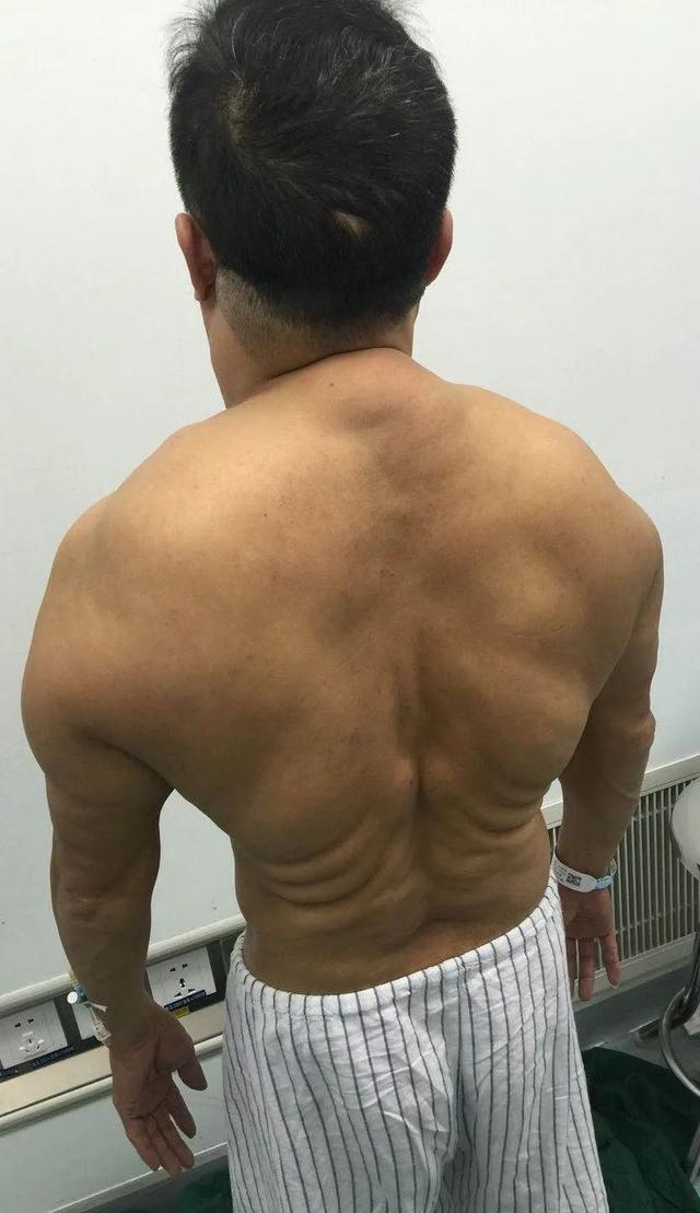 每天喝1斤多白酒,连喝30多年,厦门一大叔脖子粗成“牛颈”!休闲区蓝鸢梦想 - Www.slyday.coM 每天喝1斤多白酒,连喝30多年,厦门一大叔脖子粗成“牛颈”!休闲区蓝鸢梦想 - Www.slyday.coM