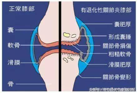 滑膜炎膝盖疼怎么办教你2个方法积液肿胀都消失