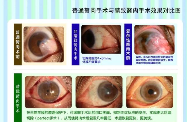 眼睛突然长出"小翅膀"要注意,这是一种翼状胬肉眼病