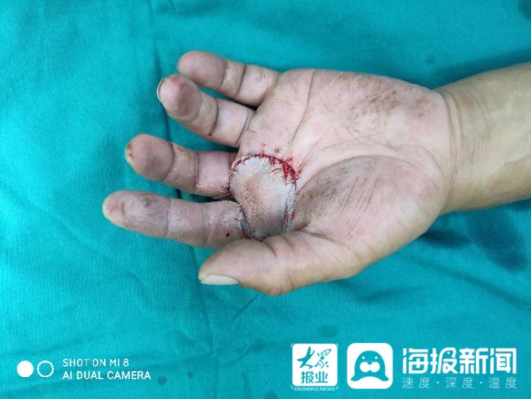 无影针密缝5小时!聊城市人民医院东昌府院区成功完成断掌再植手术