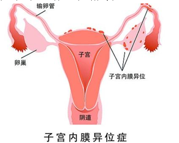 痛经就是子宫内膜异位症吗?济南青华医院医生为您解析!