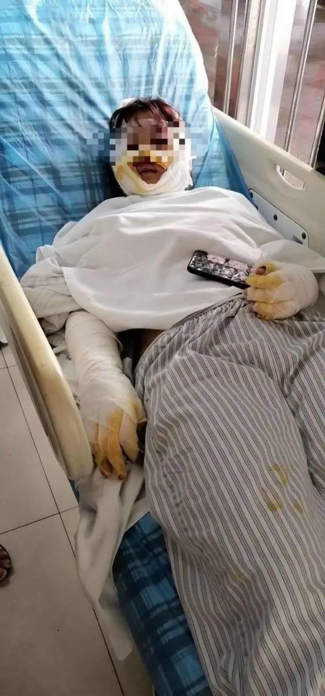 阳江一女子被前男友泼硫酸