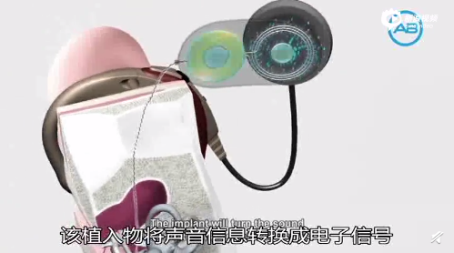 人工耳蜗,没用?