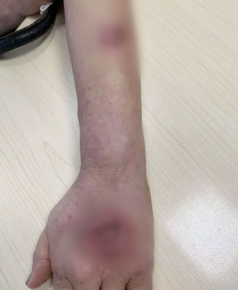 警惕!不小心刺了一下,女子手背长出大窟窿,差点截肢!