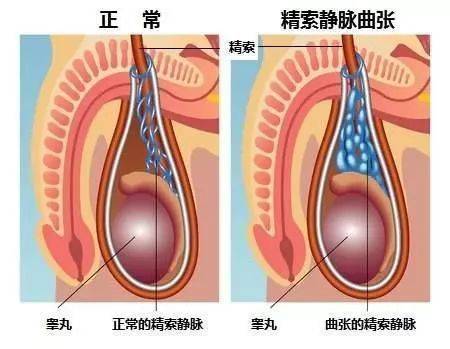 正文    由于患侧睾丸血流不畅,静脉血流滞留,阴囊温度比正常侧高0.