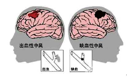 天呀!预防可怕的脑中风,原来这么简单!但还有很多人不知道