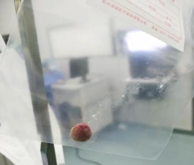 高烧39℃、胸腔积液、大片阻塞性肺炎……只因吃这个美食