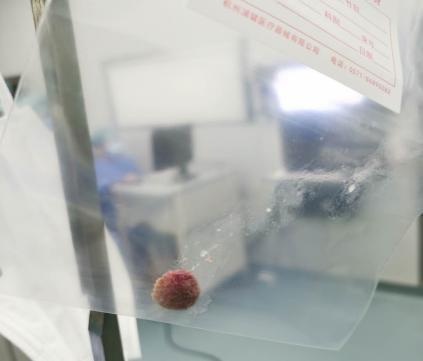 80岁老伯高烧39℃、胸闷、出现阻塞性肺炎、胸腔积液,只因一颗杨梅核