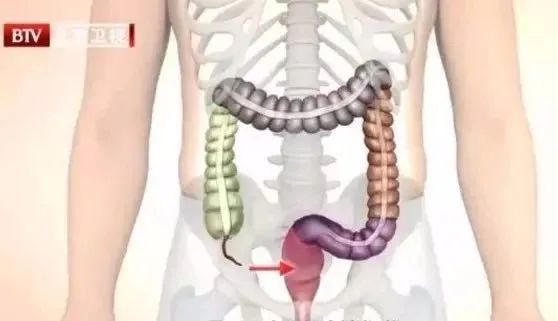 病從口入！癌癥“喜歡”的3種腸道，看看你有嗎？這些行為一定得改~